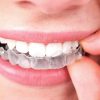 primeros dias invisalign