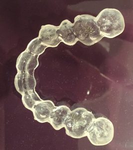 aligner invisalign