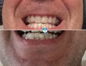 comparativa invisalign