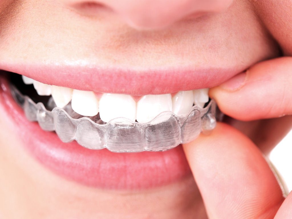 primeros dias invisalign