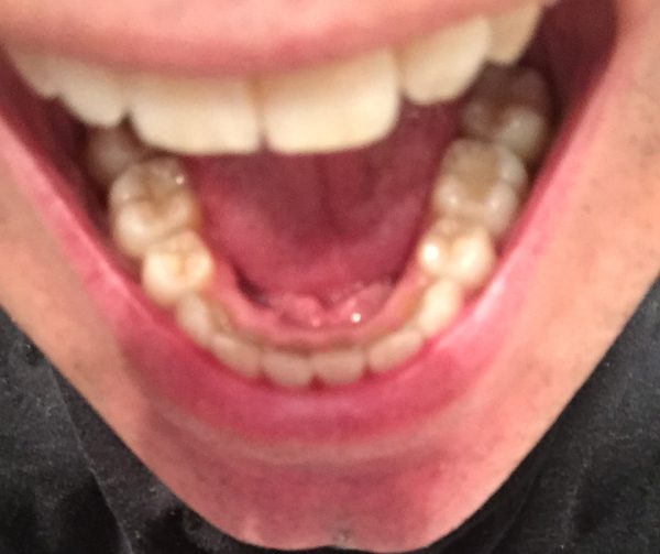 retenedor invisalign